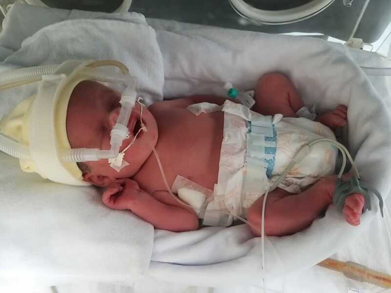 Bebê que sofreu cirurgia rara ainda no ventre da mãe completa um ano de vida