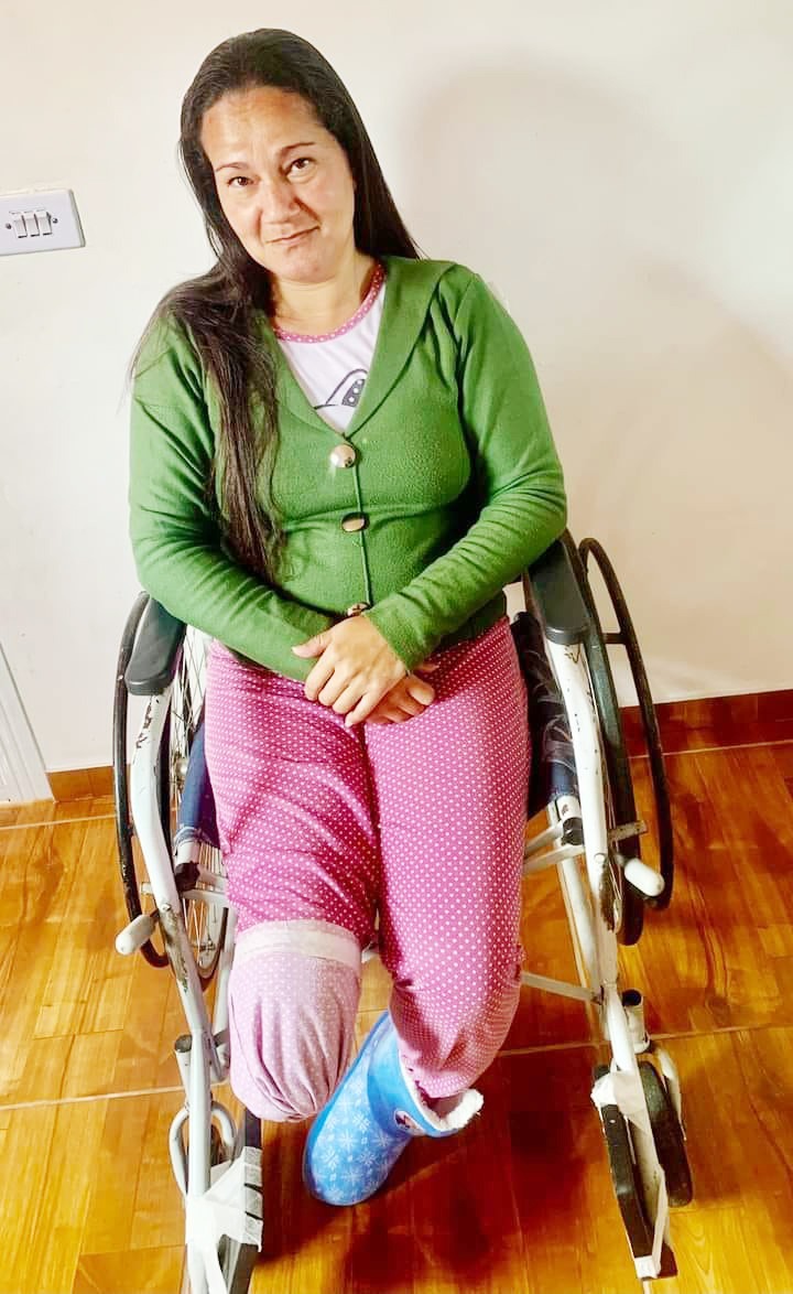 Mulher que perdeu a perna em acidente de moto pede ajuda para comprar prótese