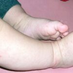 Pediatra alerta sobre cuidados com a doença “mão-pé-boca” em crianças menores de 5 anos