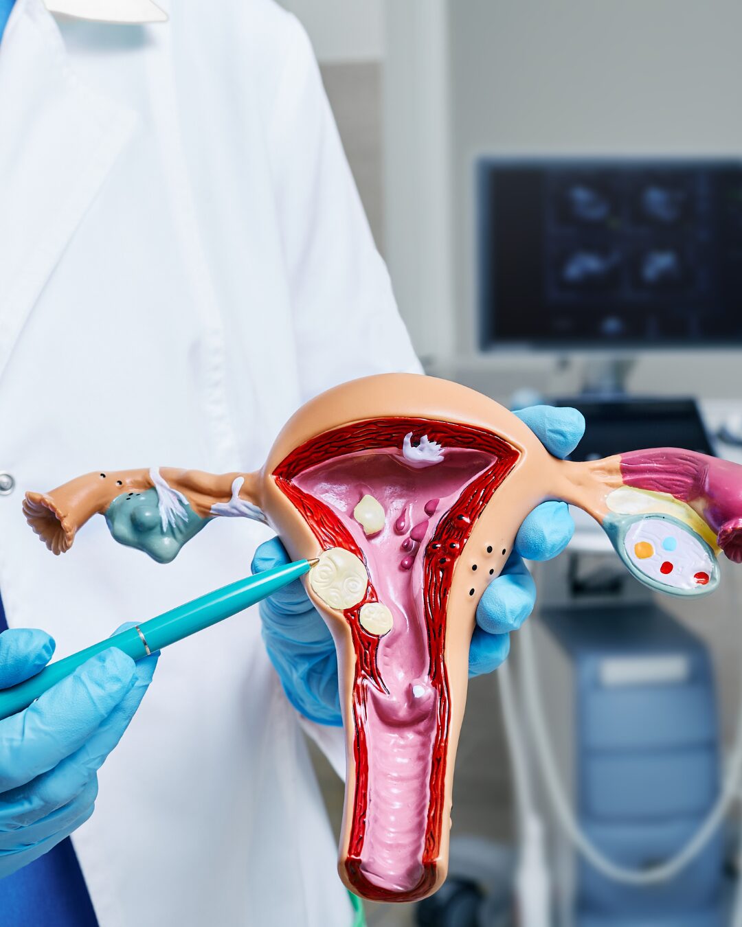 Mioma uterino: conheça a condição que afeta a vida das mulheres