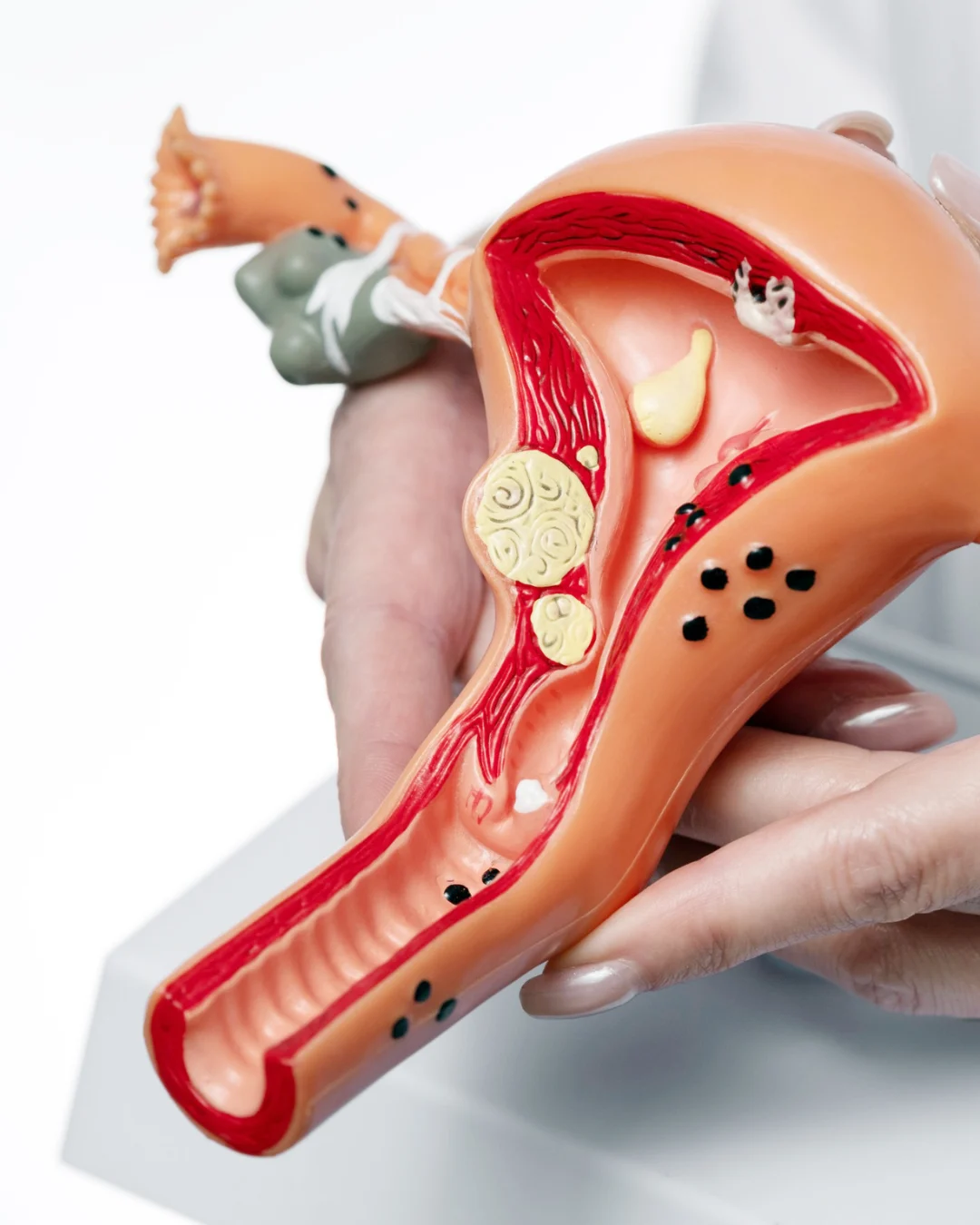 Saiba como identificar a Síndrome de Ovários Policísticos (SOP)