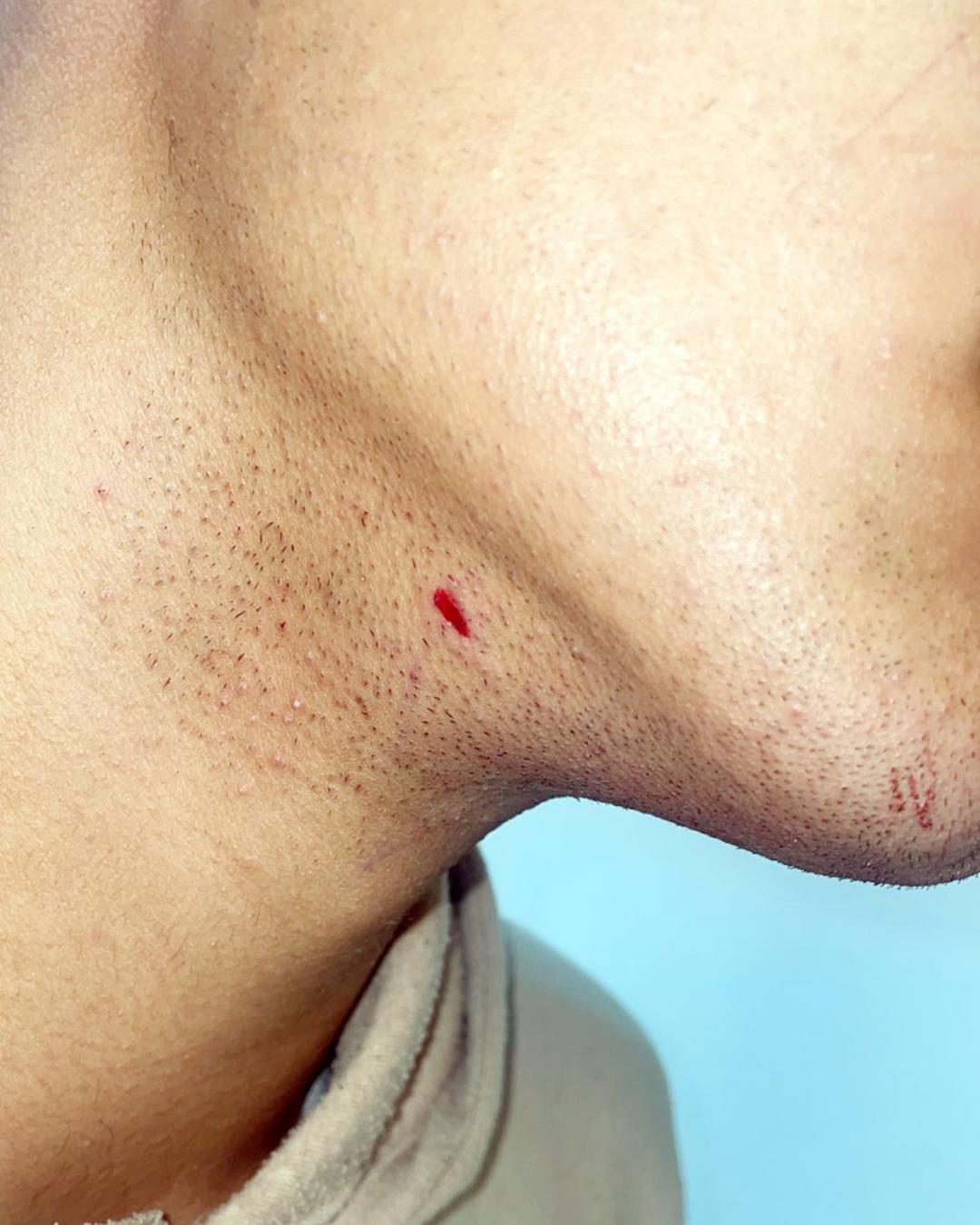 Estudante é agredido por colega com canetada no pescoço durante aula