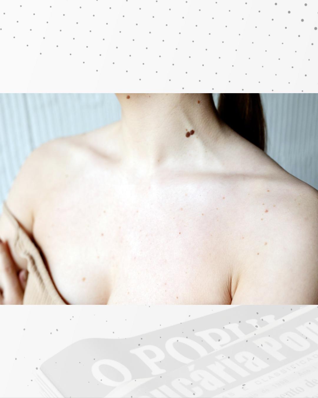 Reforce os cuidados com a pele no verão para evitar câncer de pele