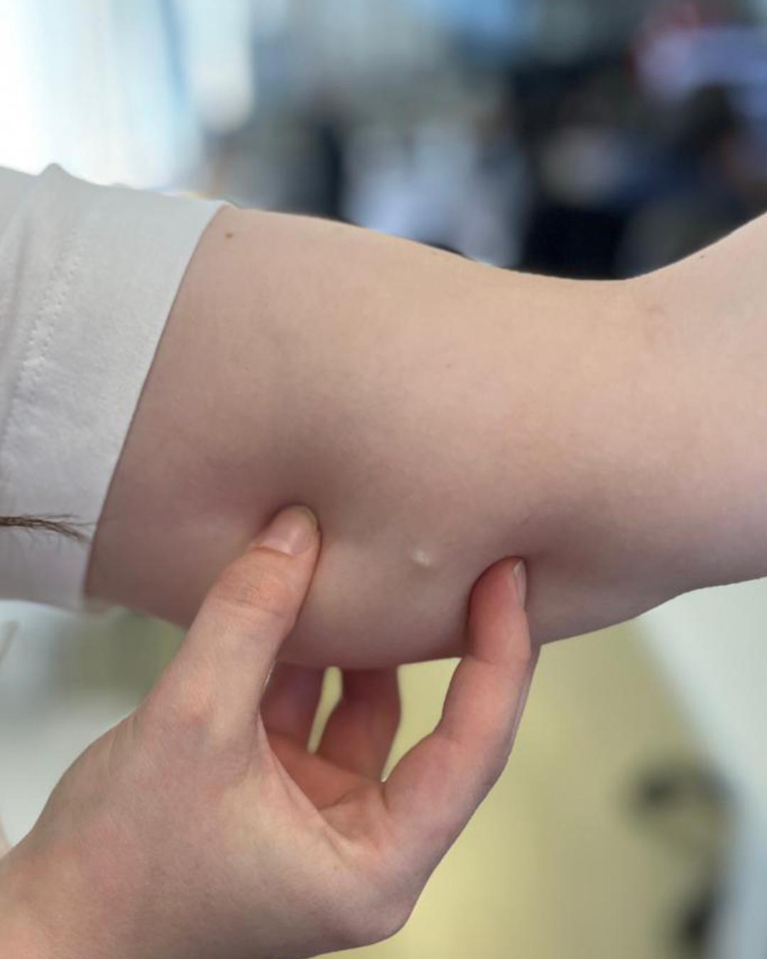 Araucária se prepara para iniciar aplicação do implante contraceptivo Implanon na rede pública