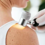 Mutirão de atendimentos dermatológicos será realizado no CEMO