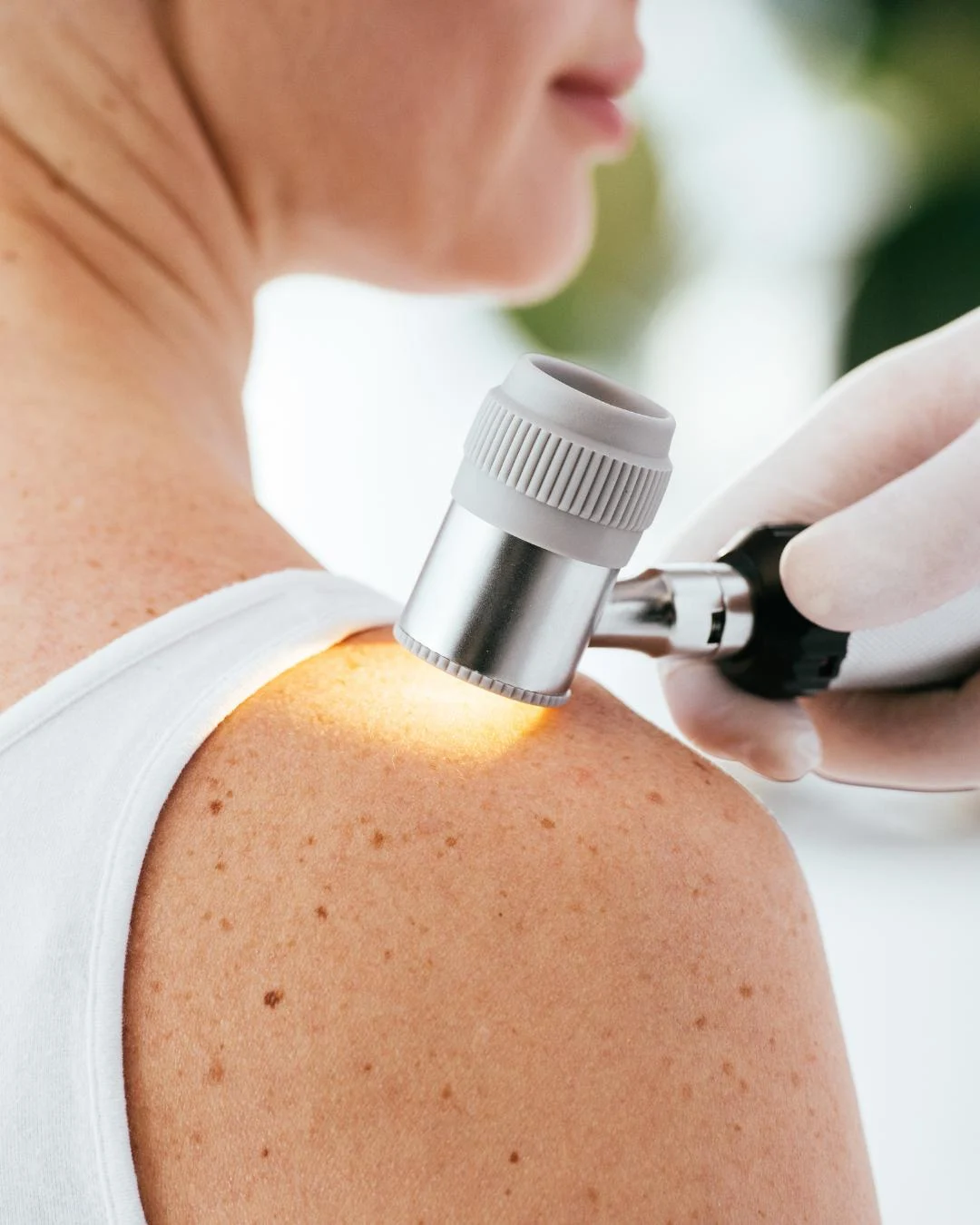 Mutirão de atendimentos dermatológicos será realizado no CEMO